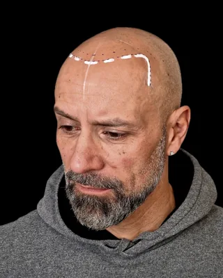 Avant la micropigmentation, avec le dessin préparatoire de la ligne frontale