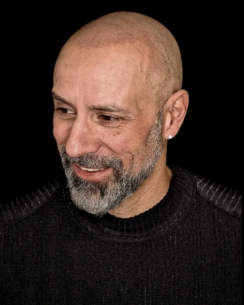 Résultat réel de micropigmentation capillaire effet rasé chez JM.Micro